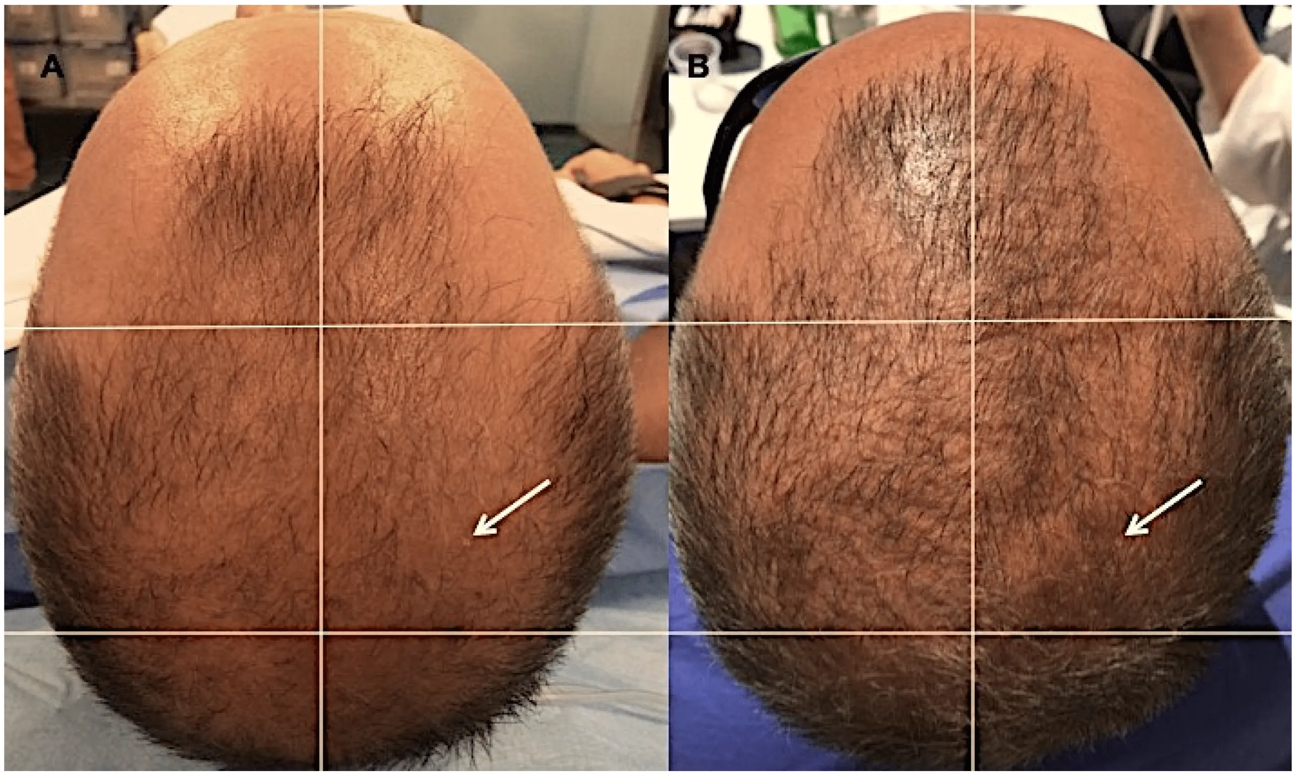 Fat cells for hair growth