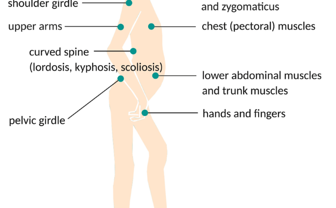 Fat-sex dystrophy &#8211; symptoms and causes