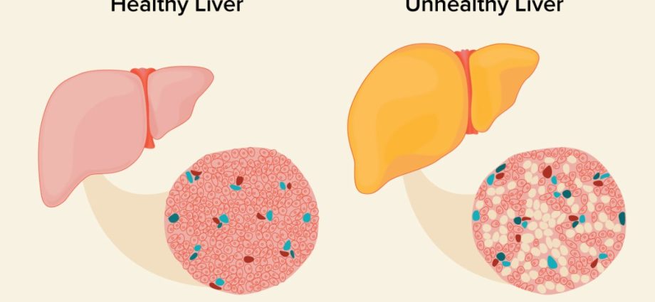 Fatty liver &#8211; how serious are the symptoms?