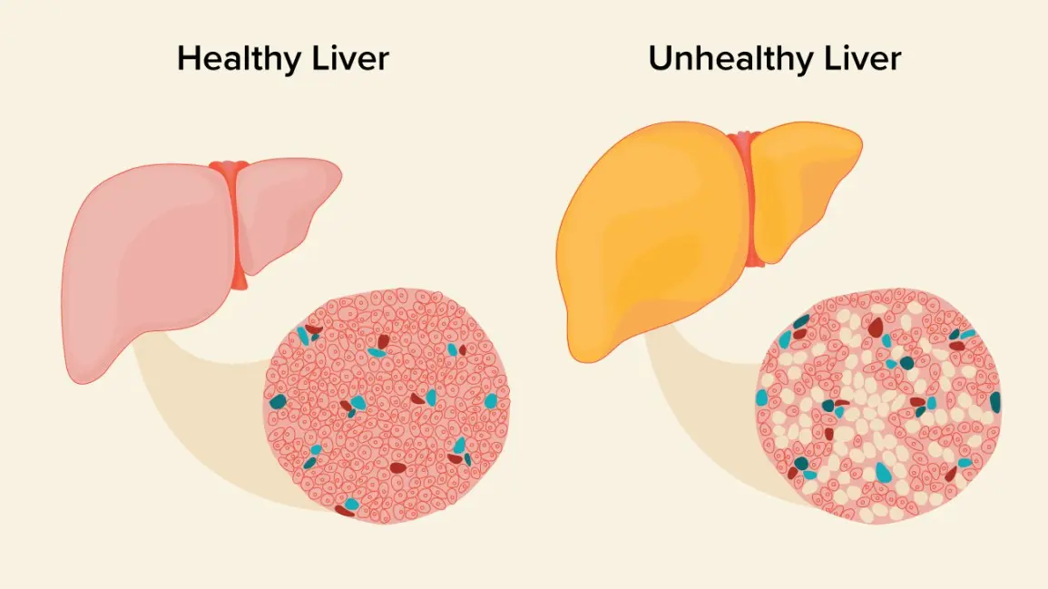 Fatty liver &#8211; how serious are the symptoms?