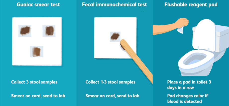 Fecal occult blood test &#8211; when to perform, how to prepare, interpretation of results