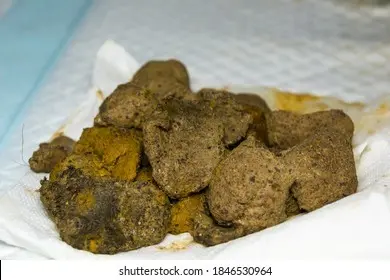 Fecal stones