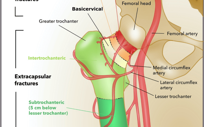 Femur fractures &#8211; symptoms. What is the treatment of a shaft and peripheral femoral fracture?