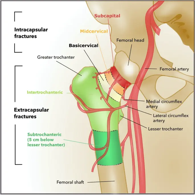 Femur fractures &#8211; symptoms. What is the treatment of a shaft and peripheral femoral fracture?