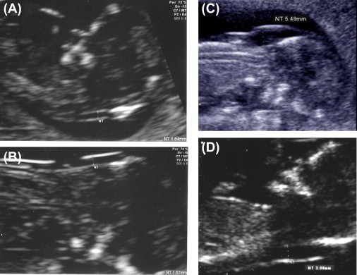 Fetal neck translucency &#8211; reliability of the test result