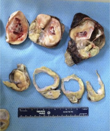 Fetus in fetu. Unusual twin pregnancy