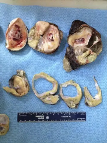 Fetus in fetu. Unusual twin pregnancy