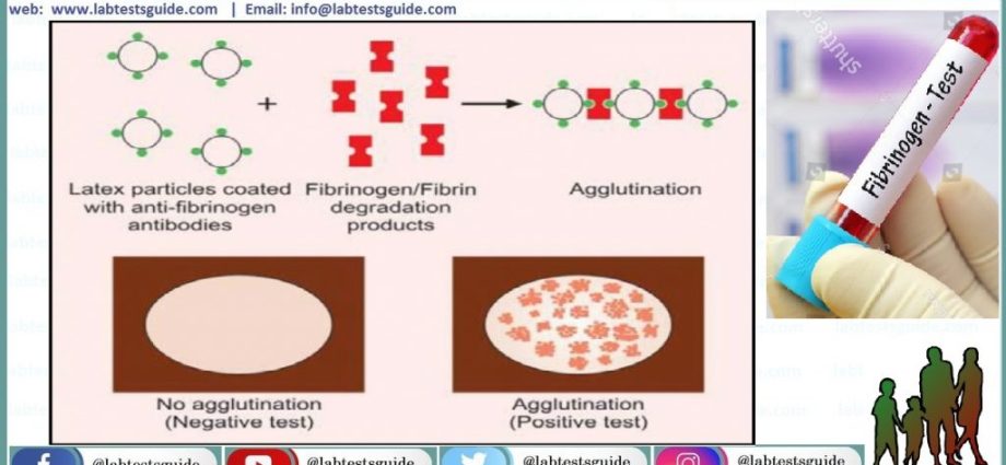 Fibrinogen &#8211; when we determine the course of the test, deviations from the norm. What does decreased or elevated fibrinogen mean?