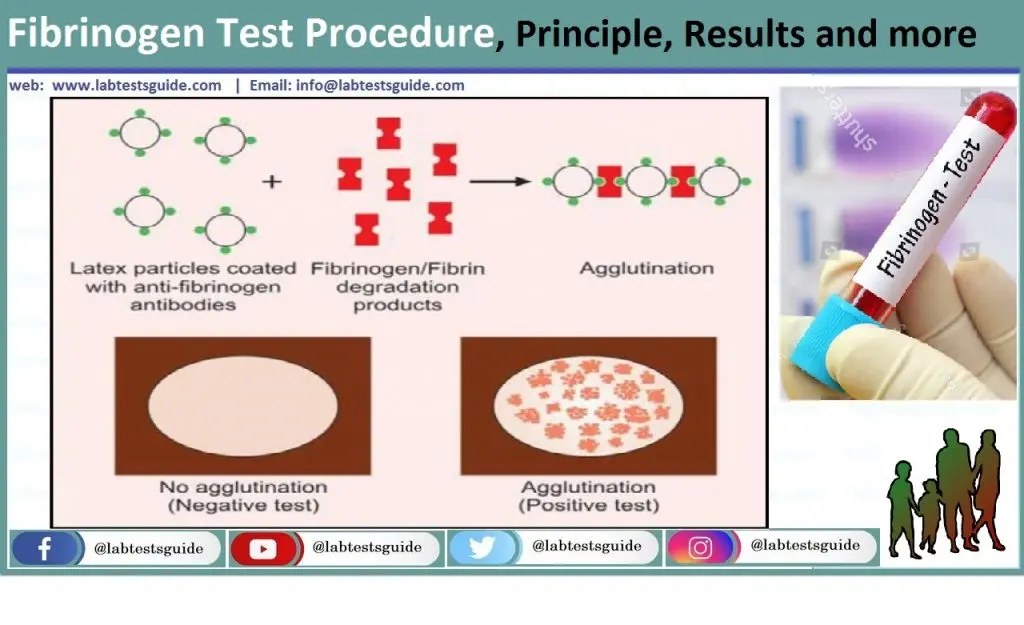 Fibrinogen &#8211; when we determine the course of the test, deviations from the norm. What does decreased or elevated fibrinogen mean?