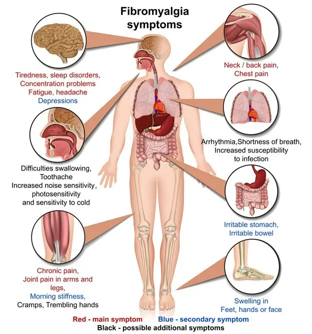 Fibromyalgia &#8211; difficult pain diagnosis and treatment