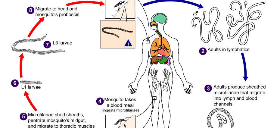 Filariasis &#8211; Symptoms and Treatment