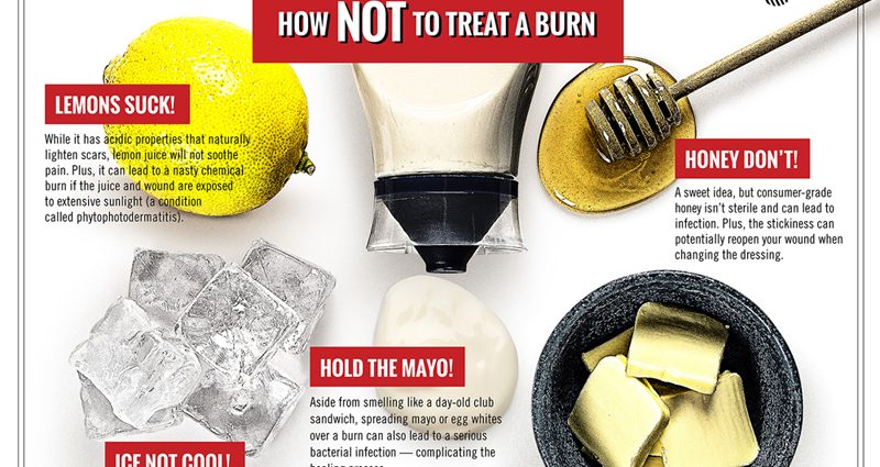 Find out about the most effective home remedies for burns