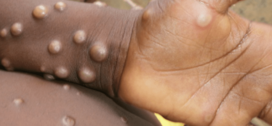 First case of monkey pox in Germany