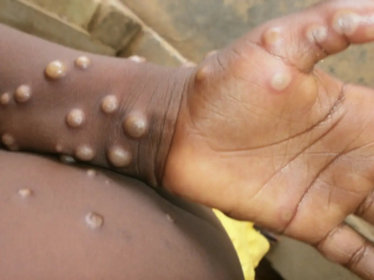 First case of monkey pox in Germany