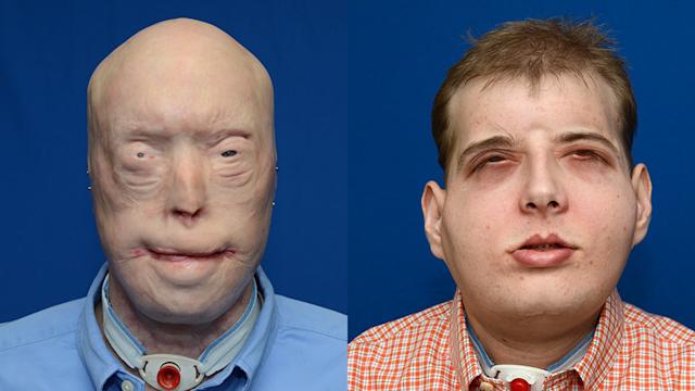 First-ever successful double hand and face transplant. &#8220;It&#8217;s a medical miracle&#8221;