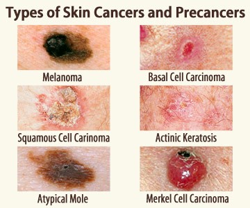 Five atypical signs of skin cancer