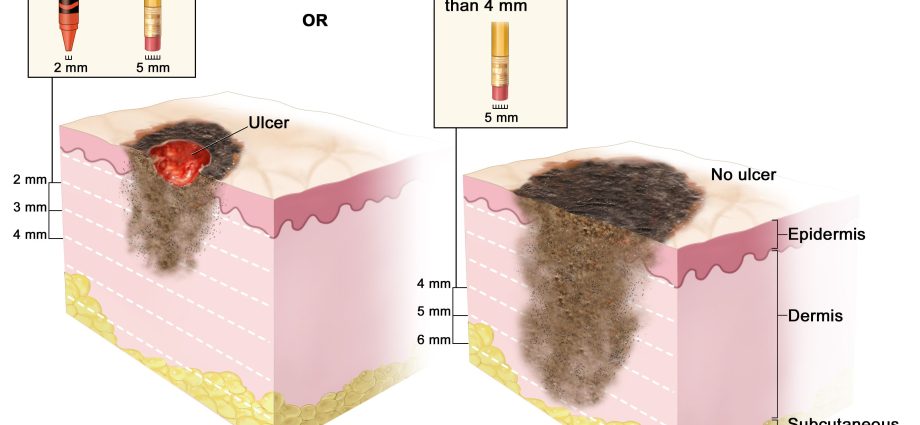 Five common habits that can end up in skin cancer, including melanoma