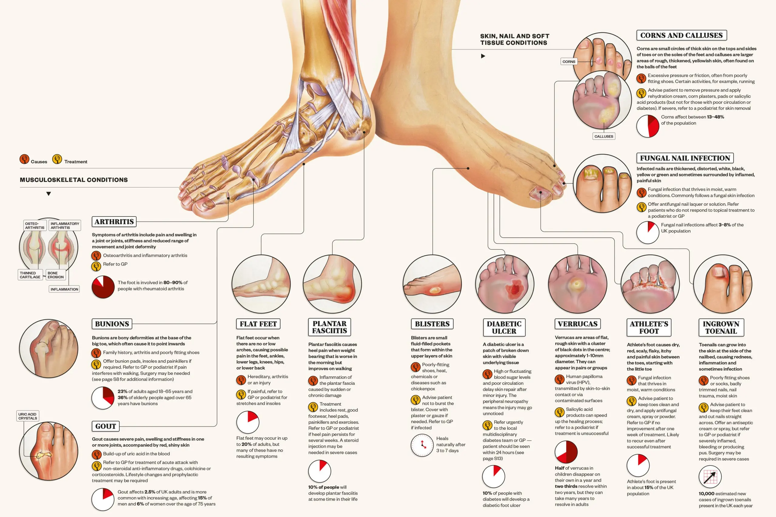 Five diseases that can be seen on the feet