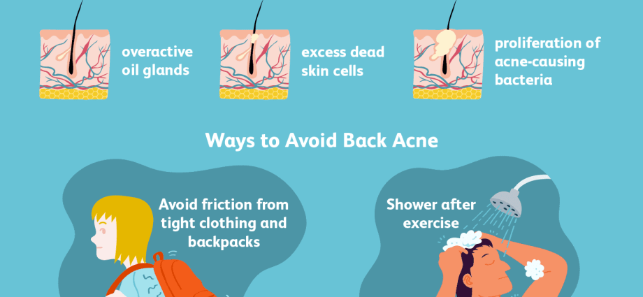 Five factors that contribute to the development of acne