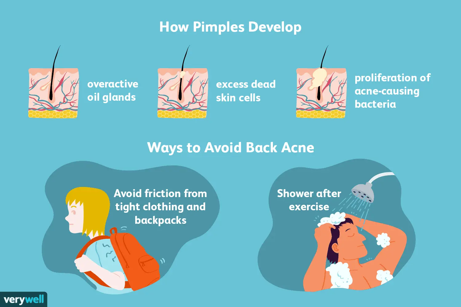 Five factors that contribute to the development of acne