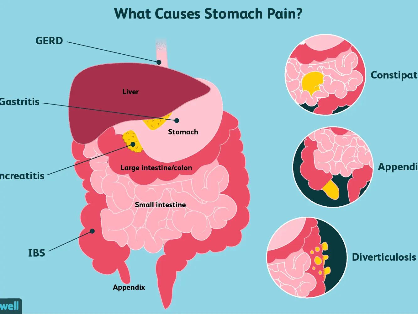 Five signs it&#8217;s not your usual stomach ache. When to see a doctor?