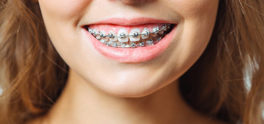 Fixed braces &#8211; types, prices, rules of use and hygiene