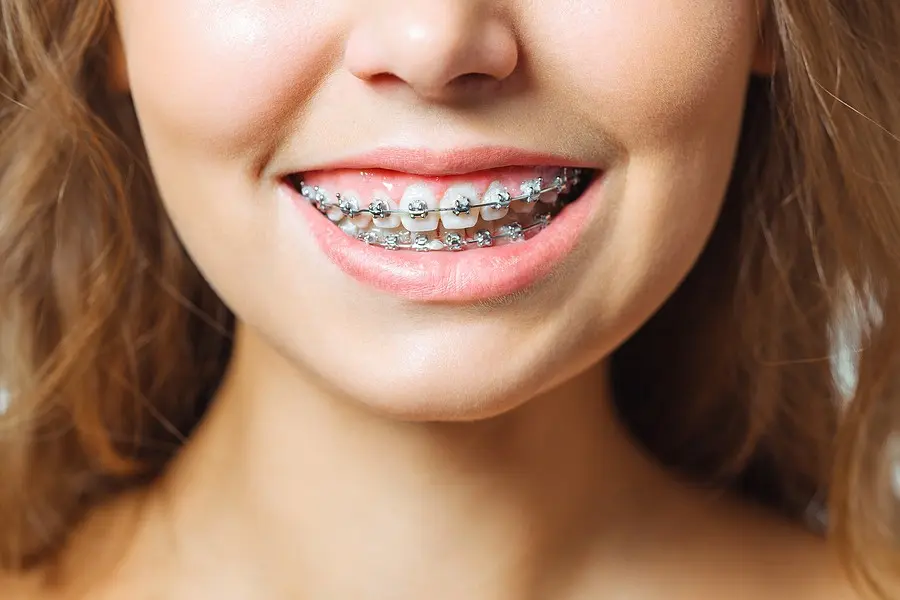 Fixed braces &#8211; types, prices, rules of use and hygiene