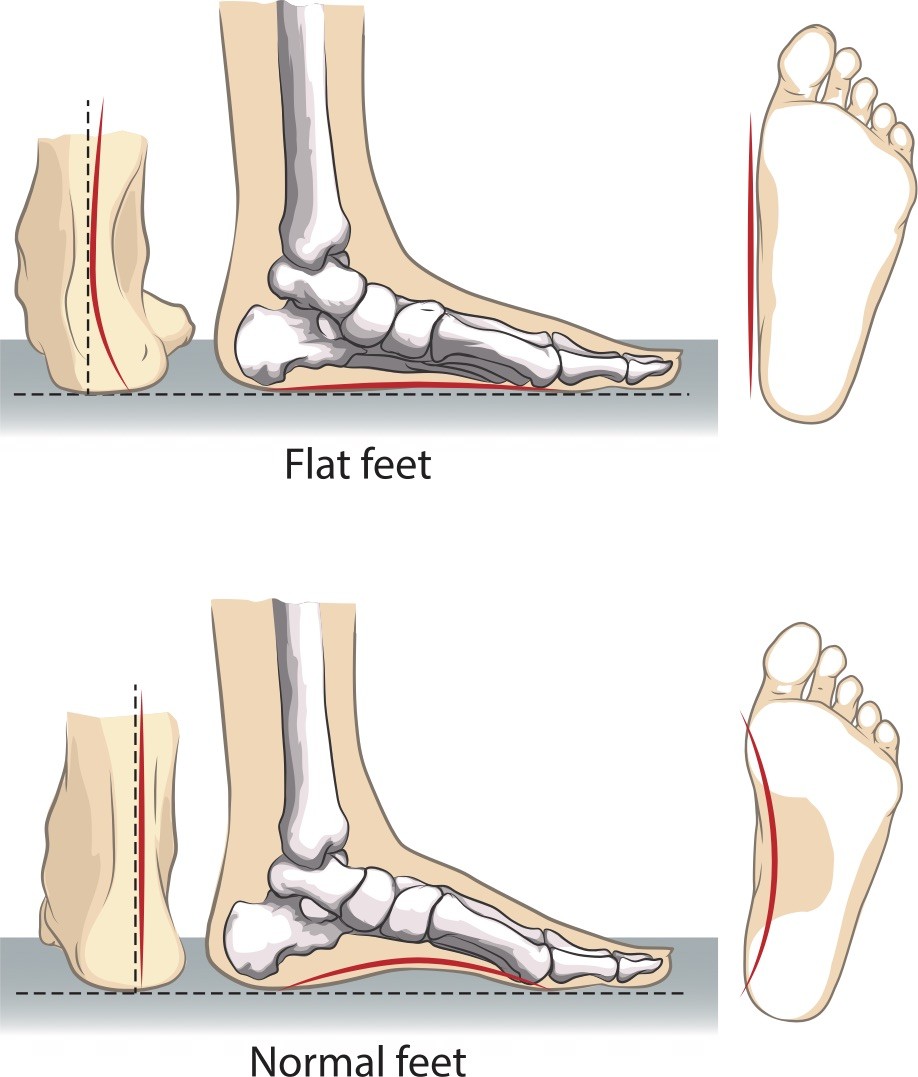 Flat feet what is it, causes, symptoms. Flat feet test and treatment