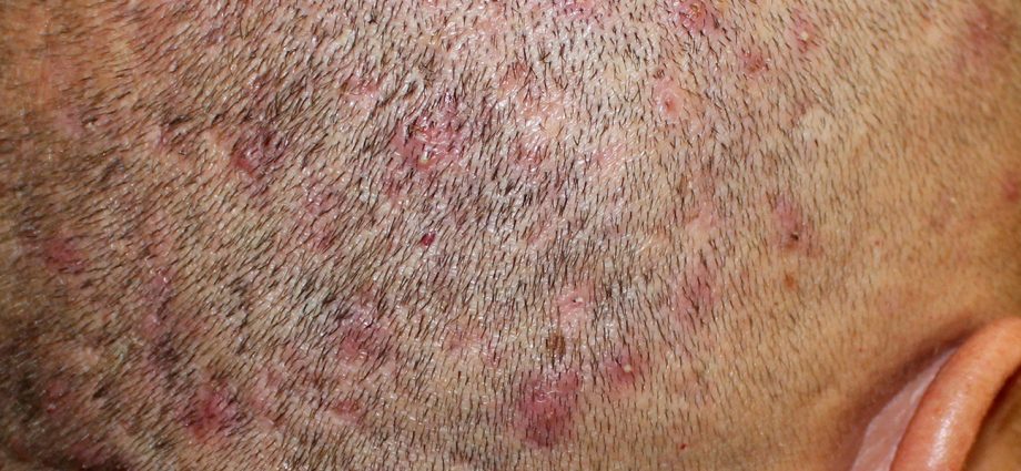 Folliculitis &#8211; causes, symptoms, treatment