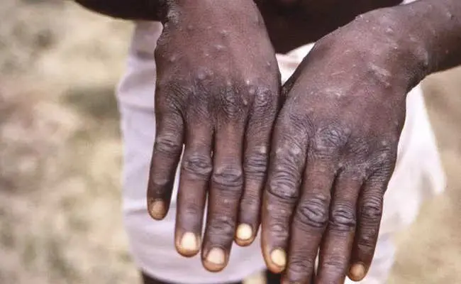 For years, scientists have warned against the &#8220;revival&#8221; of monkey pox. They were right