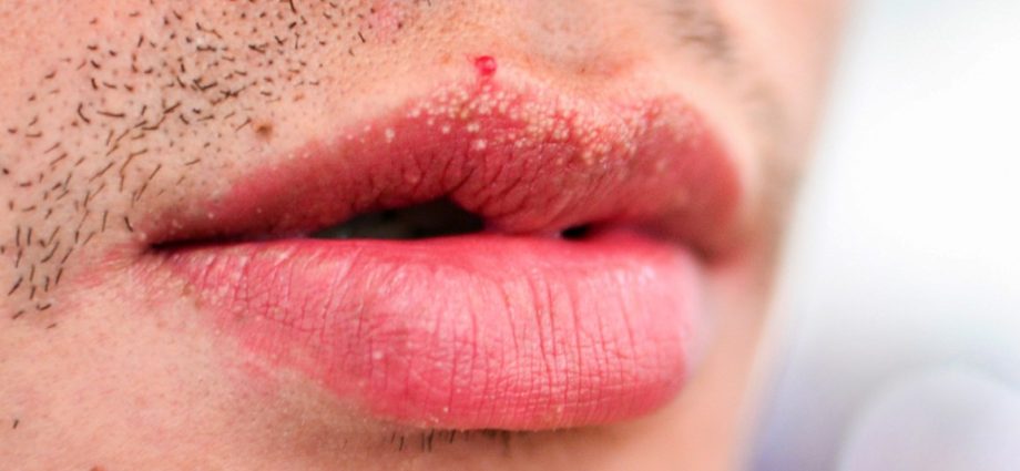Fordyce pimples. When they appear on the lips or under the eyes, they may foreshadow heart problems