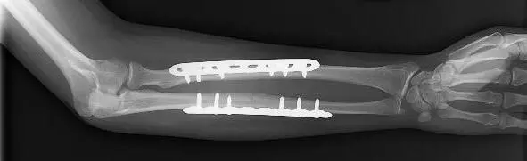 Forearm fractures &#8211; treatment