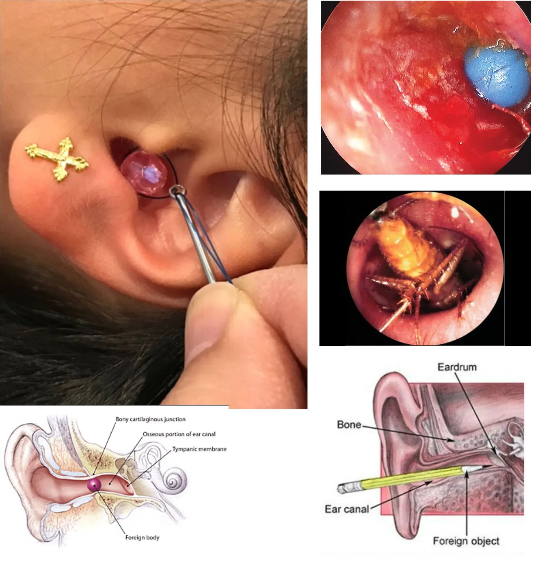 Foreign bodies in the ear &#8211; how to remove them? Symptoms of a foreign body in the ear