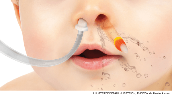 Foreign bodies in the nose &#8211; symptoms and first aid