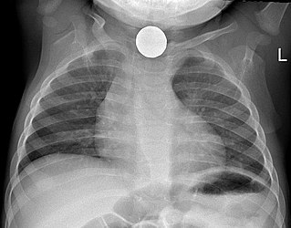 Foreign bodies in the respiratory tract