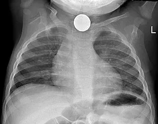 Foreign bodies in the respiratory tract