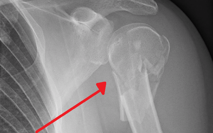 Fracture of the humerus