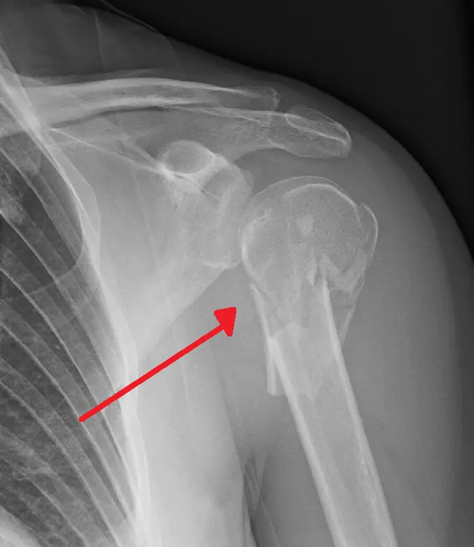 Fracture of the humerus