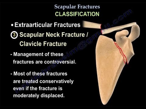 Fracture of the scapula &#8211; treatment