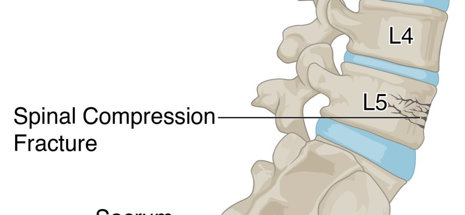 Fractures of the spine