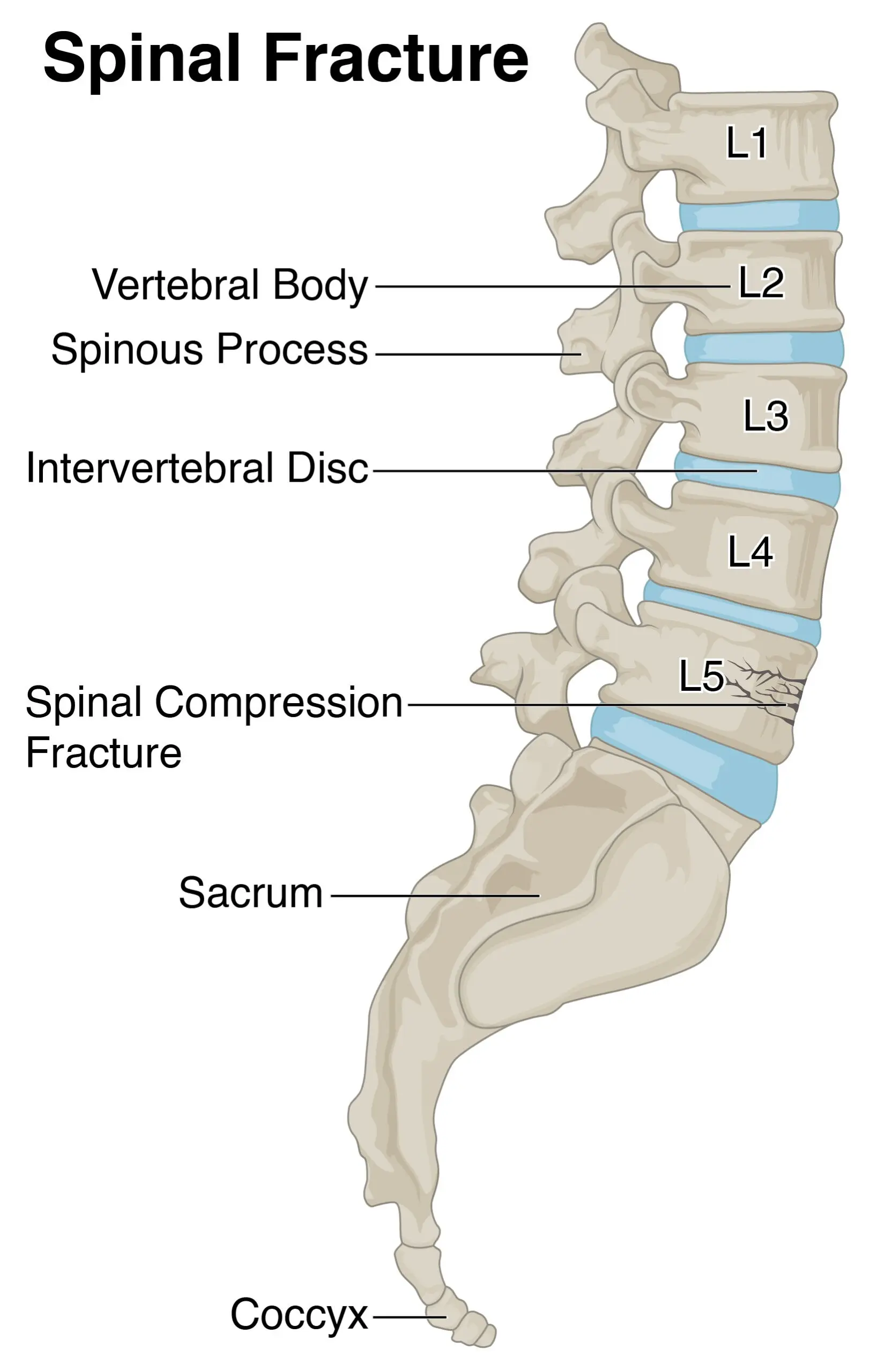 Fractures of the spine