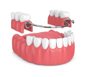 Frame denture for teeth &#8211; when can it be needed? How Much Does a Frame Denture Cost?