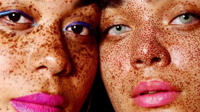 Freckles &#8211; why do they appear? How to whiten freckles?