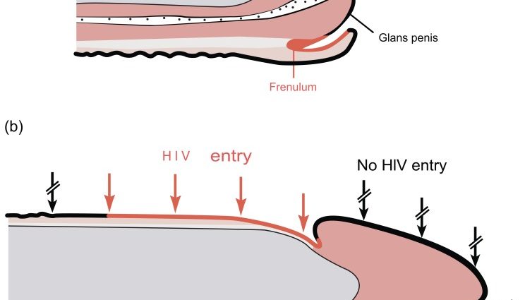 Frenulum of the foreskin &#8211; operation, indications, side effects. Shortening the frenulum of the foreskin