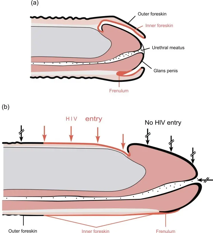 Frenulum of the foreskin &#8211; operation, indications, side effects. Shortening the frenulum of the foreskin