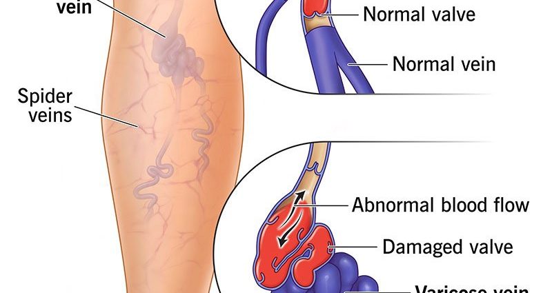 From vein to varicose veins