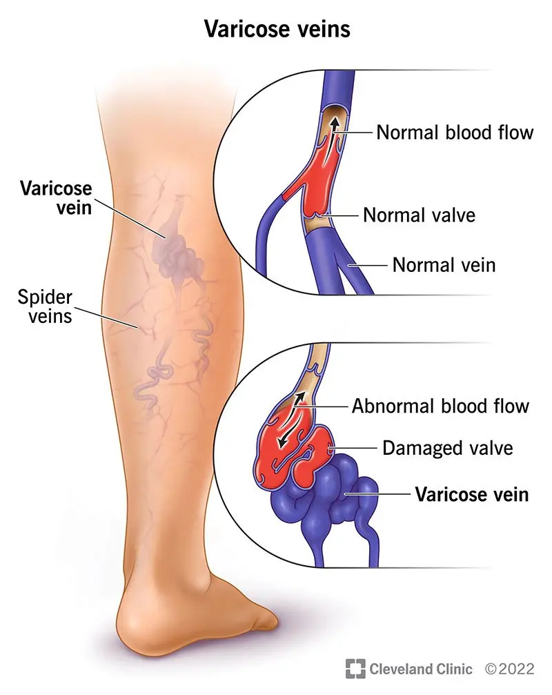 From vein to varicose veins