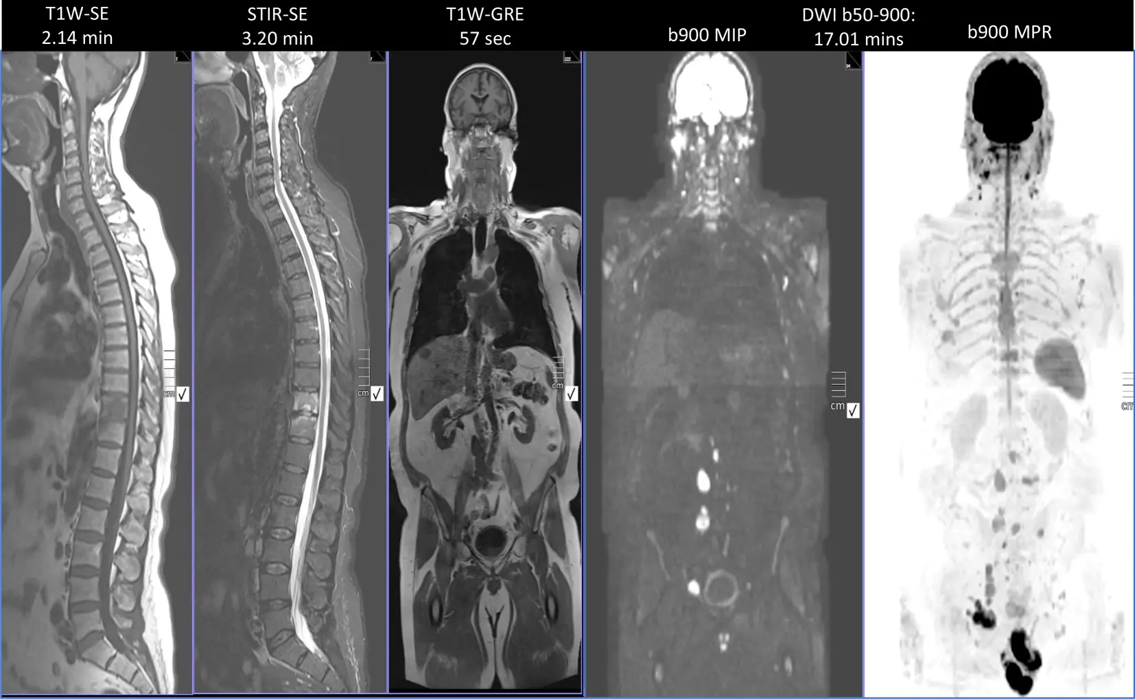 Full body magnetic resonance imaging. When to do and what is it?