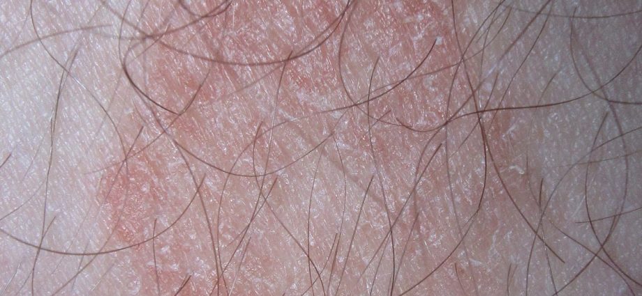 Fungal infections of the skin