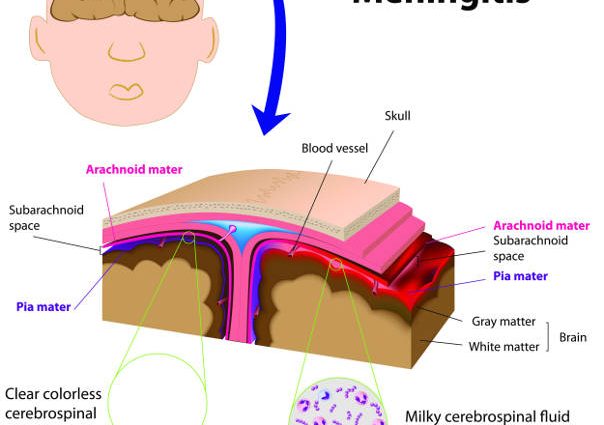 Fungal inflammation of the meninges and the brain